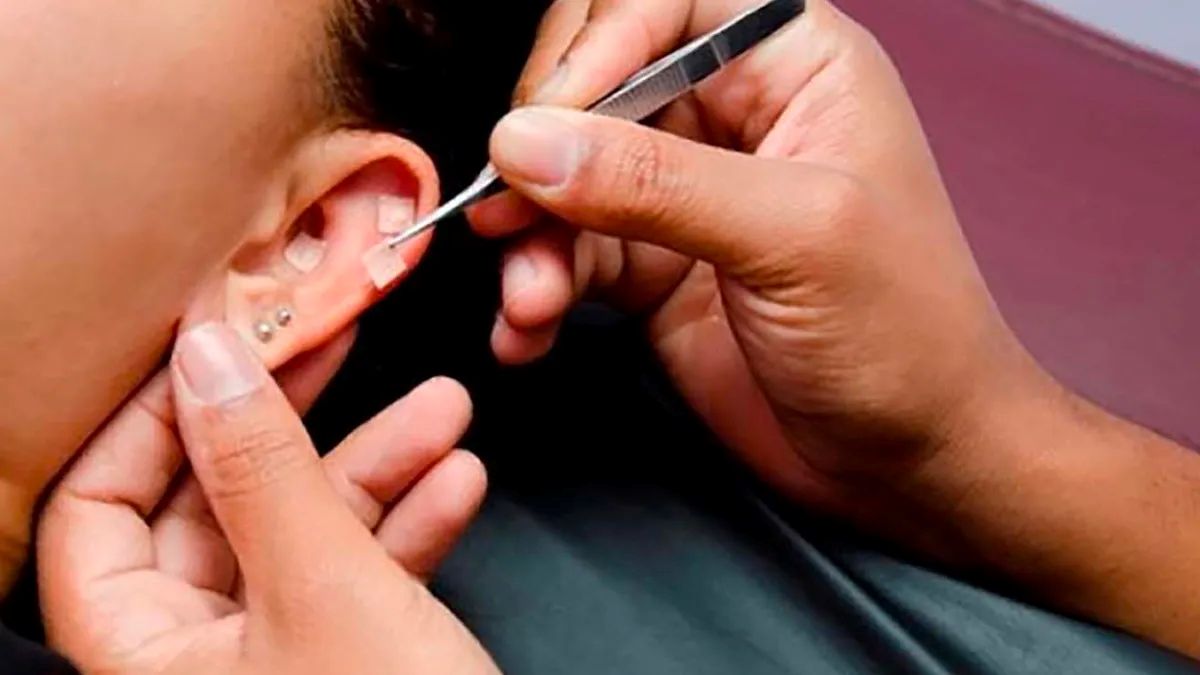 Auriculoterapia — imagem 1 de 2