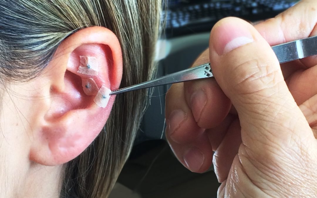 Auriculoterapia — imagem 2 de 2